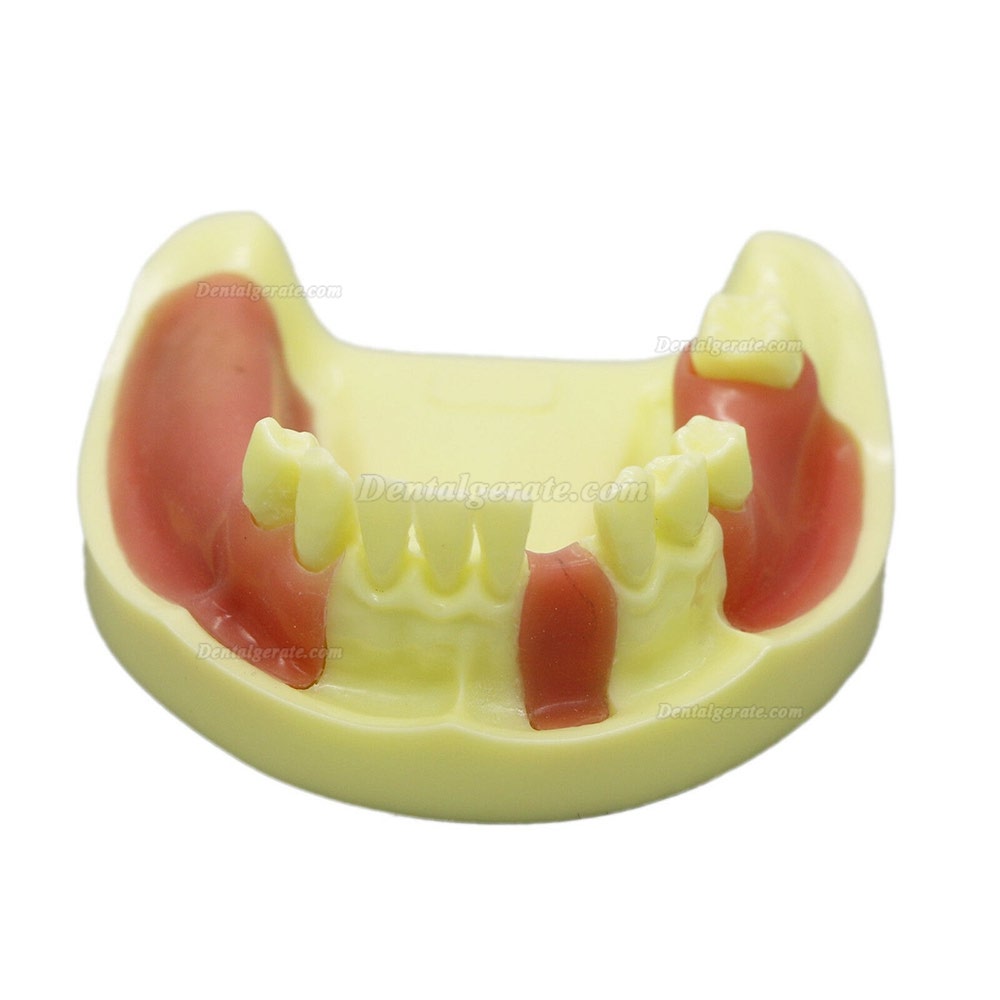 Dental Model # 2004 01 - Unterkieferimplantat-&Uuml;bungsmodell mit Gingiva